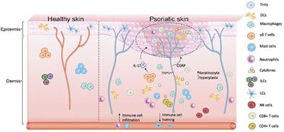 Keratinoctye-neuro-immune-units (KNICUs): collaborative impact on the initiation and maintenance of psoriasis